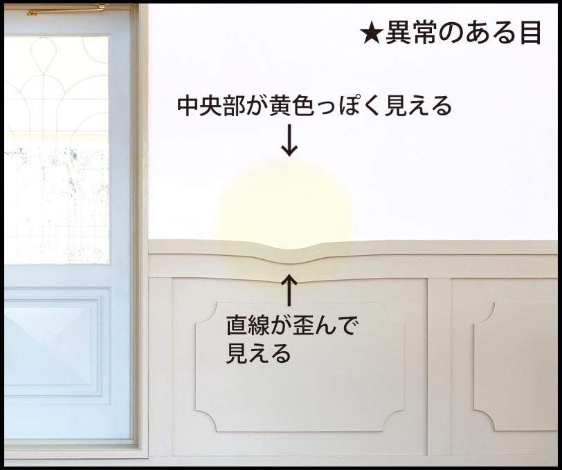 視界が歪んで見えて 中央部分が黄色っぽく見えたので眼科へ行ってきた にゃん太郎の日記